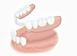 部分入れ歯